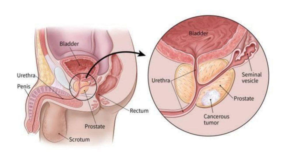 prostate cancer cause